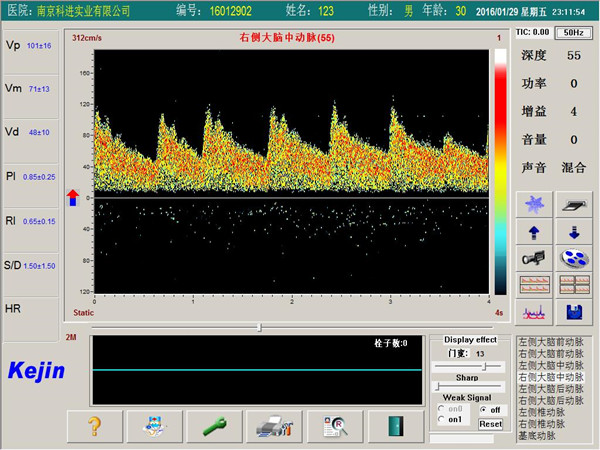 經顱多普勒軟件PW模式下單窗口檢測界面.jpg