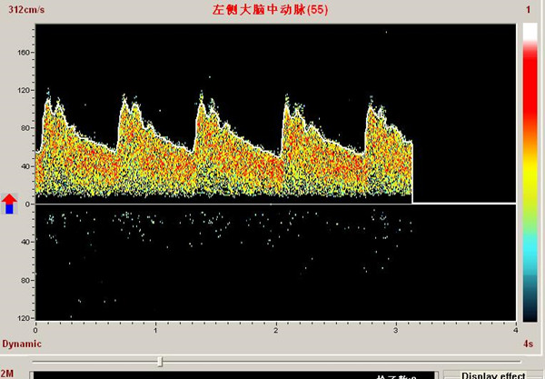 經顱多普勒PW模式下單窗口檢測頻譜
