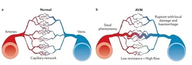 腦動靜脈畸形(AVM)的經顱多普勒表現
