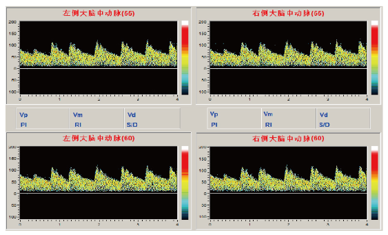 經(jīng)顱多普勒 經(jīng)顱多普勒